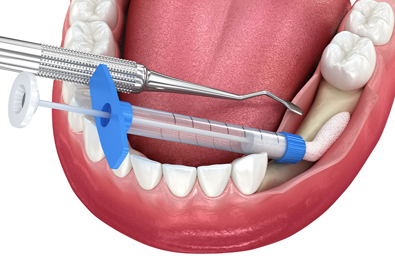 Bone Grafting in Havre de Grace