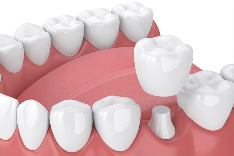 Dental Crowns in Havre de Grace