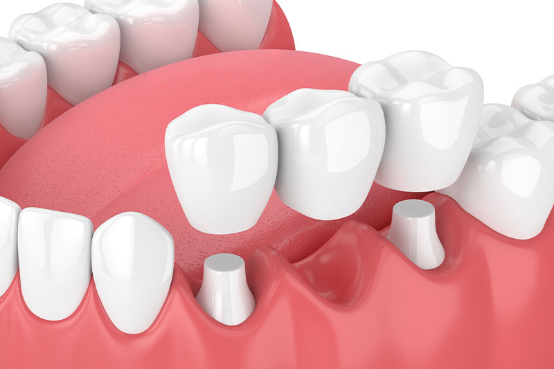 Dental Bridges in Havre de Grace