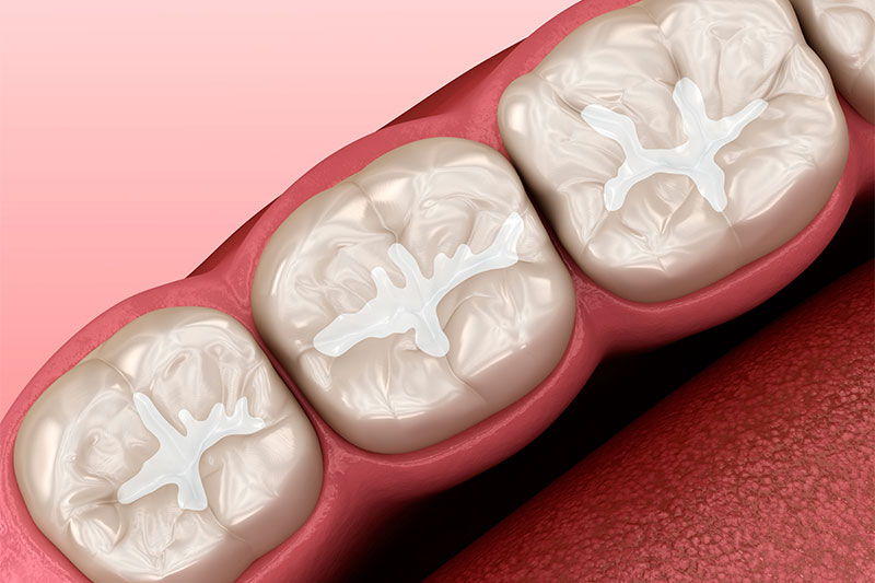 Dental Sealants in Havre de Grace