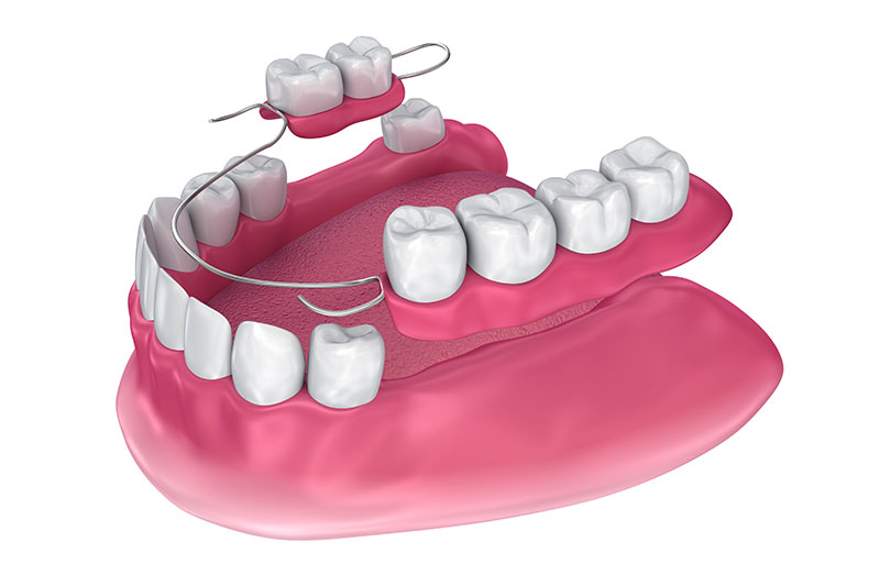 Partial Dentures in Havre de Grace