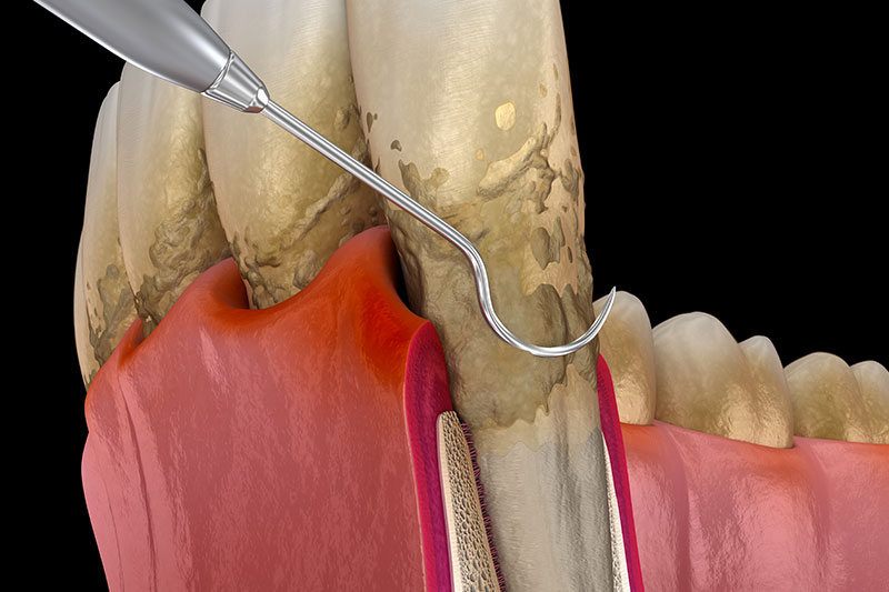 Periodontal Therapy in Havre de Grace