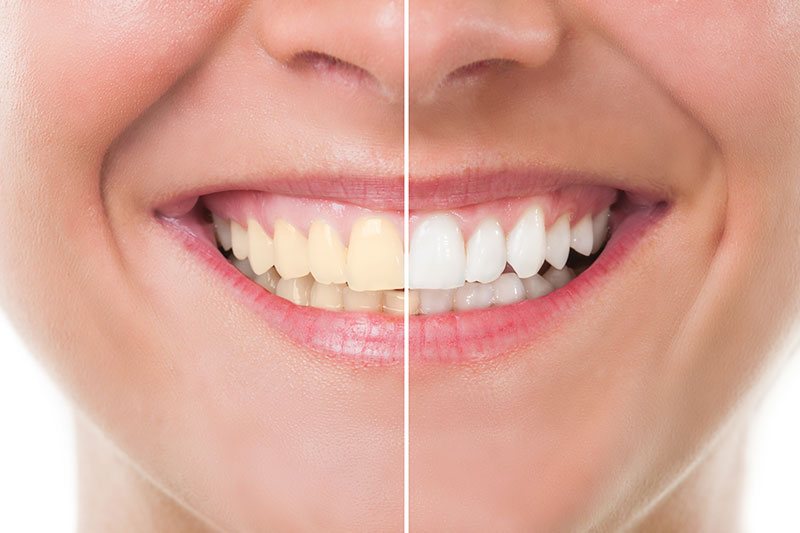 Teeth Whitening in Havre de Grace