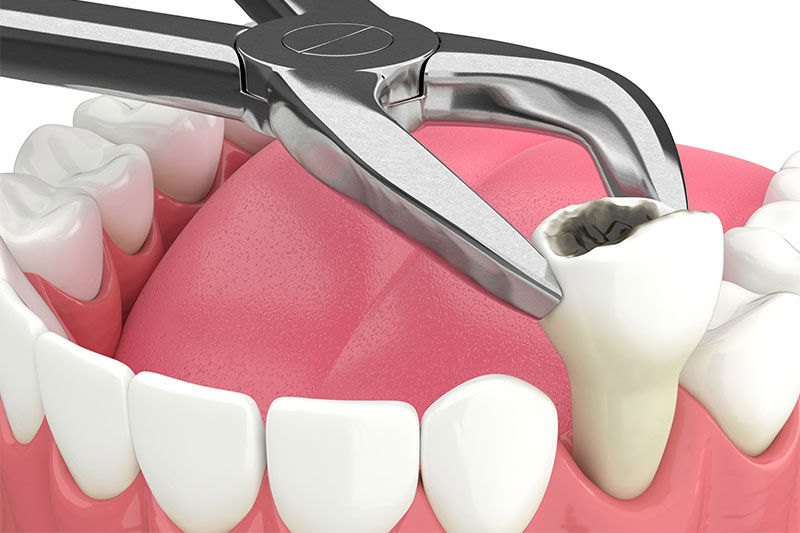 Single Tooth Extraction in Havre de Grace